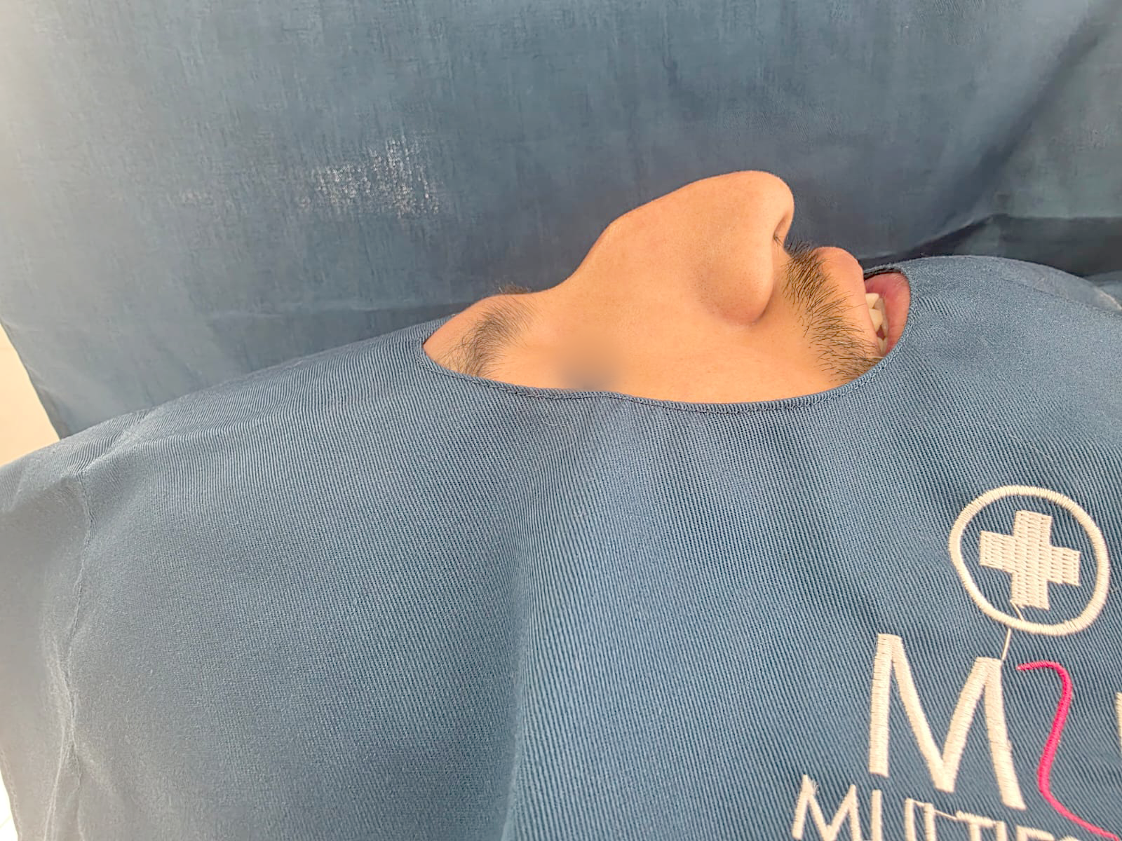 Antes de Rinoplastia — Multiestetika Médica